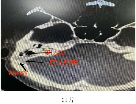 耳边出现心跳声？达州市二医院这台手术让耳朵重归安静！(图2)